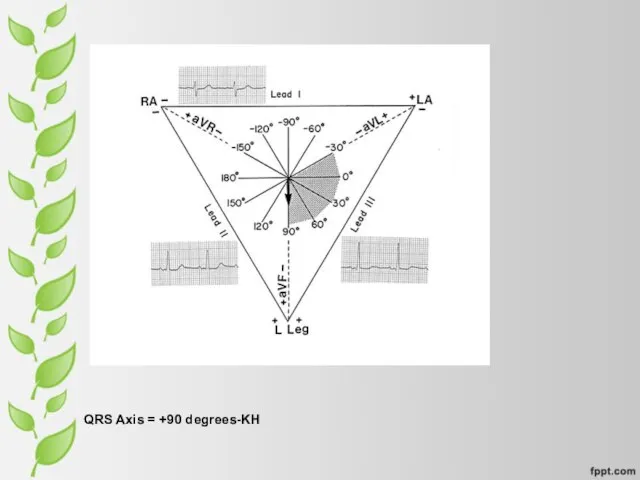 QRS Axis = +90 degrees-KH