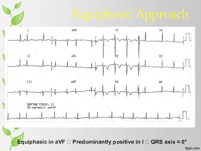 Equiphasic Approach Equiphasic in aVF ? Predominantly positive in I ? QRS axis ≈ 0°