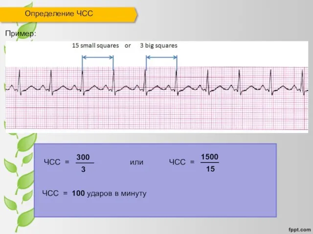 Определение ЧСС 300 ЧСС = Пример: 3 1500 15 ЧСС = или