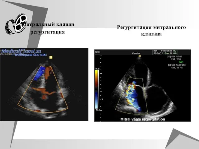 Митральный клапан регургитация Регургитация митрального клапана
