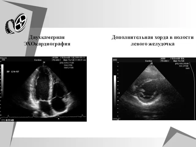 Двухкамерная ЭХОкардиография Дополнительная хорда в полости левого желудочка