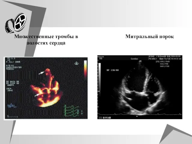 Множественные тромбы в аолостях сердца Митральный порок