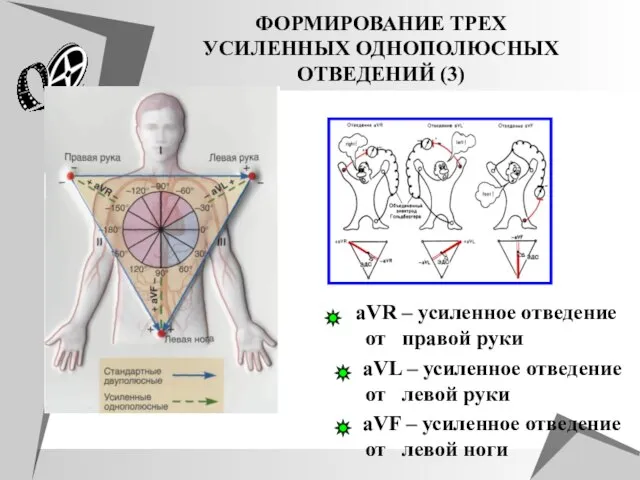 ФОРМИРОВАНИЕ ТРЕХ УСИЛЕННЫХ ОДНОПОЛЮСНЫХ ОТВЕДЕНИЙ (3) aVR – усиленное отведение от правой