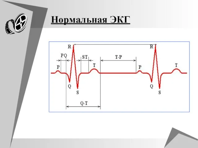 Нормальная ЭКГ