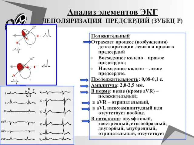 Анализ элементов ЭКГ ДЕПOЛЯРИЗАЦИЯ ПРЕДСЕРДИЙ (ЗУБЕЦ Р) Положительный Отражает процесс (возбуждения) деполяризации