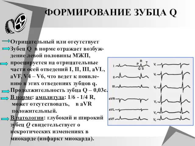 ФОРМИРОВАНИЕ ЗУБЦА Q Отрицательный или отсутствует Зубец Q в норме отражает возбуж-