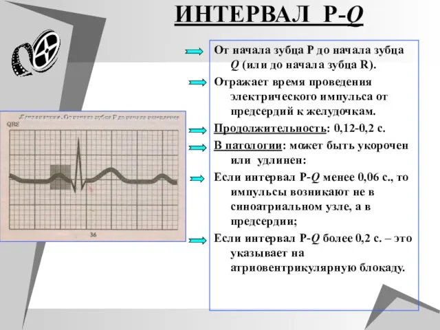 ИНТЕРВАЛ P-Q От начала зубца P до начала зубца Q (или до