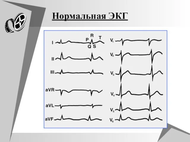 Нормальная ЭКГ