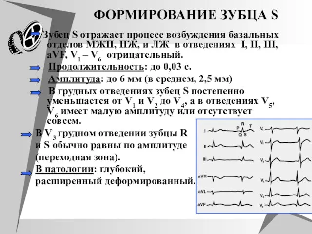 ФОРМИРОВАНИЕ ЗУБЦА S Зубец S отражает процесс возбуждения базальных отделов МЖП, ПЖ,