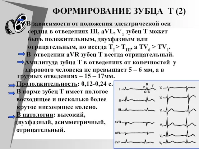 ФOРМИРOВАНИЕ ЗУБЦА T (2) В зависимости от положения электрической оси сердца в