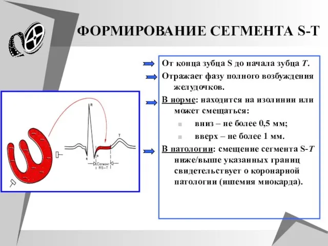 ФОРМИРОВАНИЕ СЕГМЕНТА S-T От конца зубца S до начала зубца T. Отражает