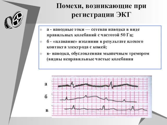 Помехи, возникающие при регистрации ЭКГ а - наводные токи — сетевая наводка