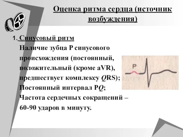 Оценка ритма сердца (источник возбуждения) 1. Синусовый ритм Наличие зубца P синусового