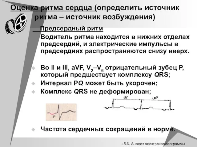 Оценка ритма сердца (определить источник ритма – источник возбуждения) Предсердный ритм Водитель