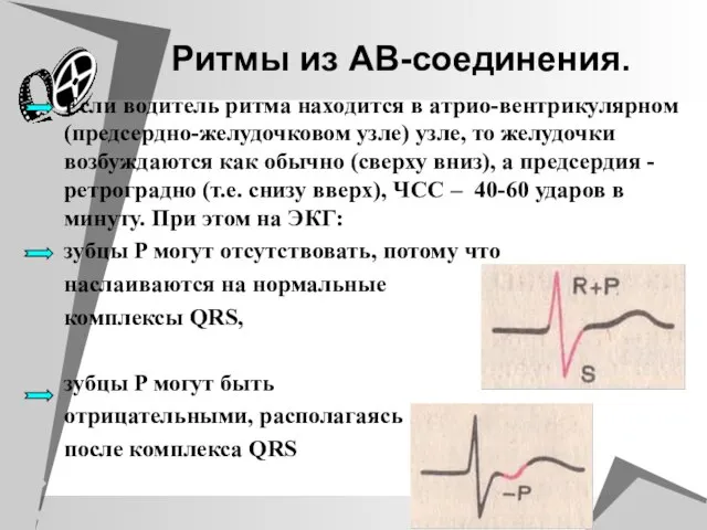 Ритмы из АВ-соединения. Если водитель ритма находится в атрио-вентрикулярном (предсердно-желудочковом узле) узле,