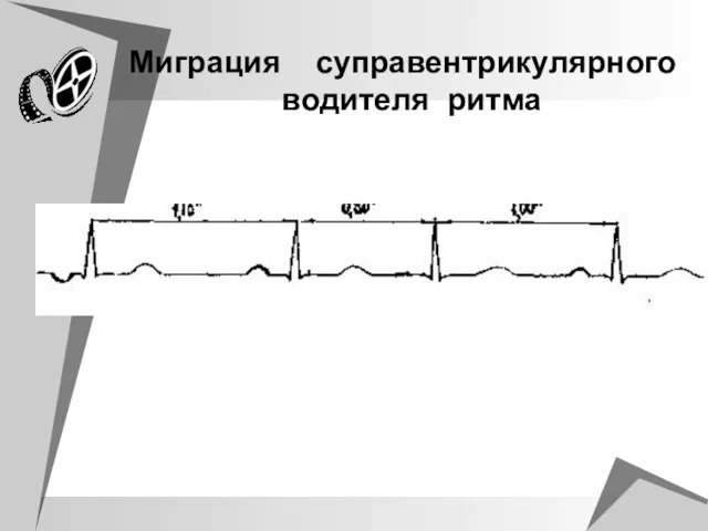 Миграция суправентрикулярного водителя ритма