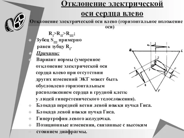 Отклонение электрической оси сердца влево Отклонение электрической оси влево (горизонтальное положение оси)