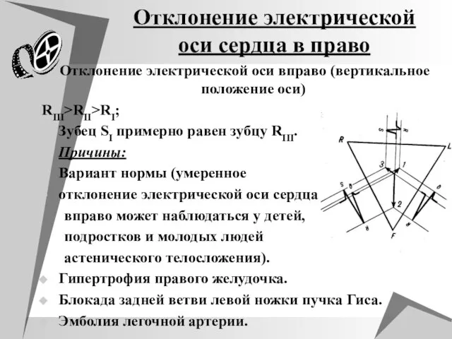 Отклонение электрической оси сердца в право Отклонение электрической оси вправо (вертикальное положение