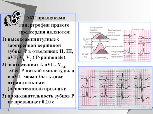 ЭКГ признаками гипертрофии правого предсердия являются: 1) высокоамплитудные с заостренной вершиной зубцы