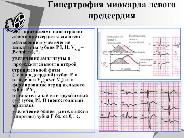 Гипертрофия миокарда левого предсердия ЭКГ-признаками гипертрофии левого предсердия являются: раздвоение и увеличение