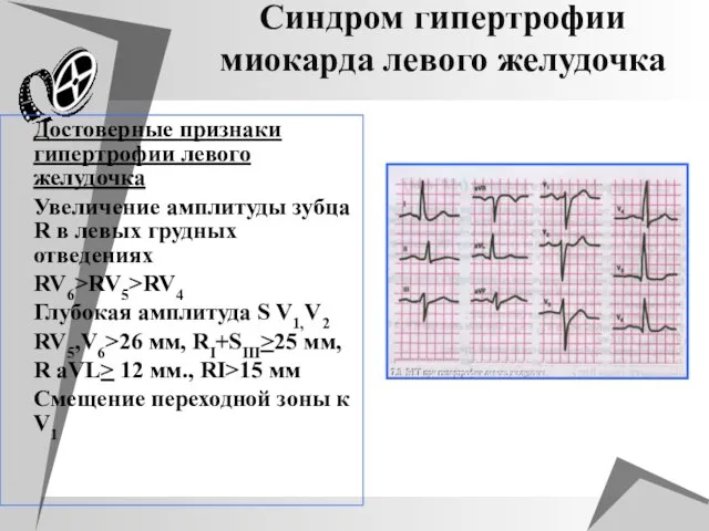 Синдром гипертрофии миокарда левого желудочка Достоверные признаки гипертрофии левого желудочка Увеличение амплитуды