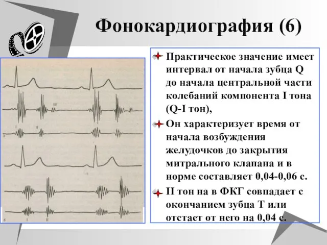 Фонокардиография (6) Практическое значение имеет интервал от начала зубца Q до начала