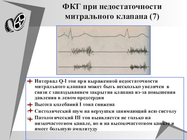 ФКГ при недостаточности митрального клапана (7) Интервал Q-I тон при выраженной недостаточности