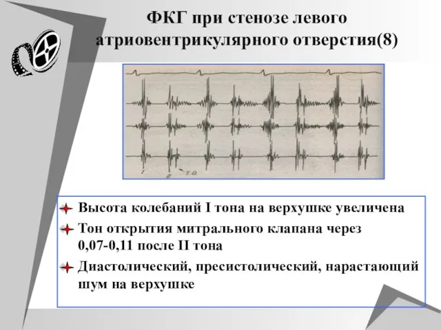 ФКГ при стенозе левого атриовентрикулярного отверстия(8) Высота колебаний I тона на верхушке