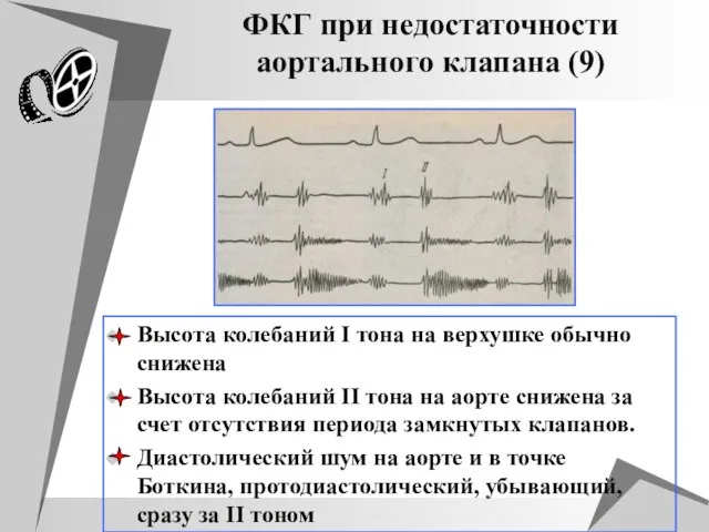 ФКГ при недостаточности аортального клапана (9) Высота колебаний I тона на верхушке