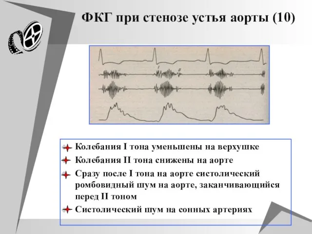 ФКГ при стенозе устья аорты (10) Колебания I тона уменьшены на верхушке