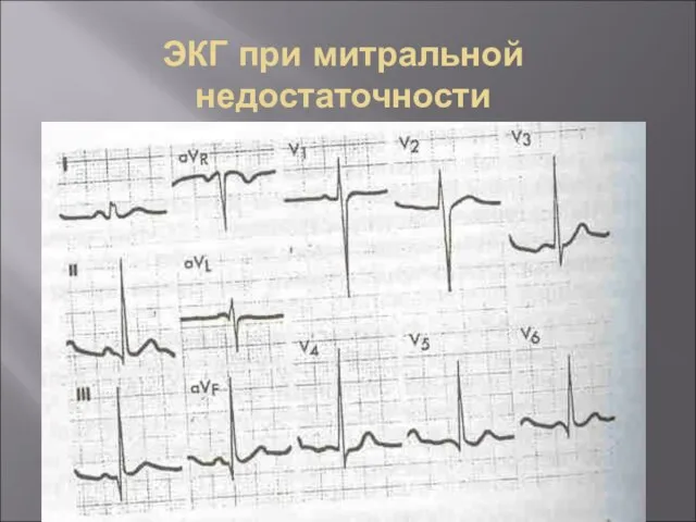 ЭКГ при митральной недостаточности