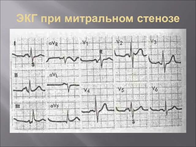 ЭКГ при митральном стенозе