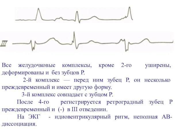 Все желудочковые комплексы, кроме 2-го уширены, деформированы и без зубцов Р. 2-й