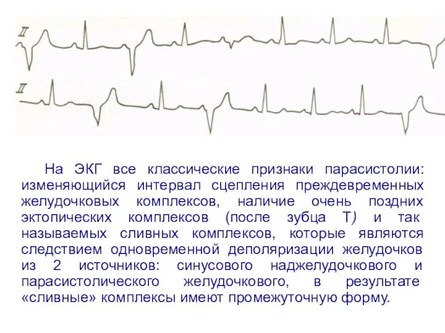 На ЭКГ все классические признаки парасистолии: изменяющийся интервал сцепления преждевременных желудочковых комплексов,