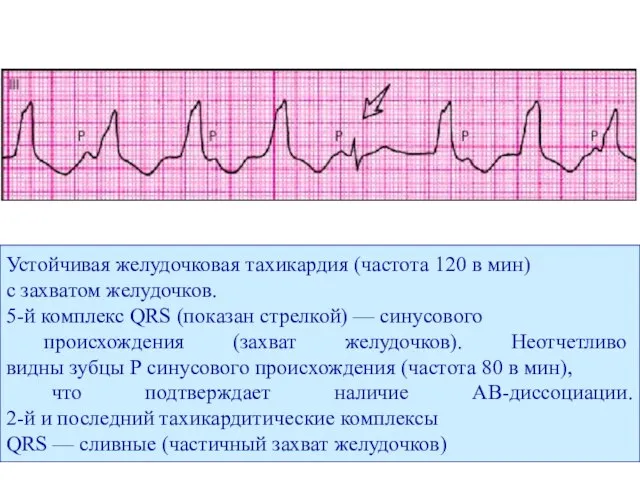 Устойчивая желудочковая тахикардия (частота 120 в мин) с захватом желудочков. 5-й комплекс