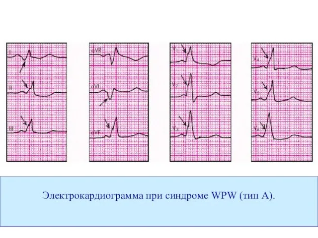 Электрокардиограмма при синдроме WPW (тип А).