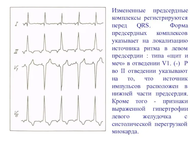 Измененные предсердные комплексы регистрируются перед QRS. Форма предсердных комплексов указывает на локализацию