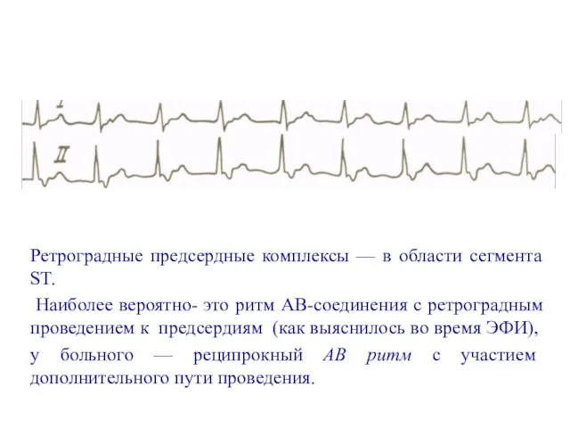 Ретроградные предсердные комплексы — в области сегмента ST. Наиболее вероятно- это ритм