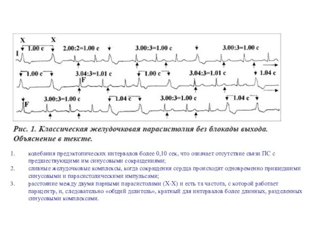 колебания предэктопических интервалов более 0,10 сек, что означает отсутствие связи ПС с