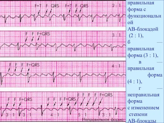 а — правильная форма с функциональной АВ-блокадой (2 : 1), б —