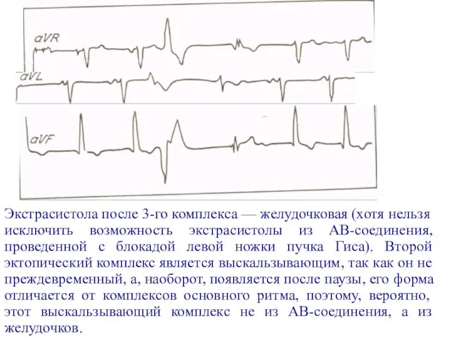 Экстрасистола после 3-го комплекса — желудочковая (хотя нельзя исключить возможность экстрасистолы из