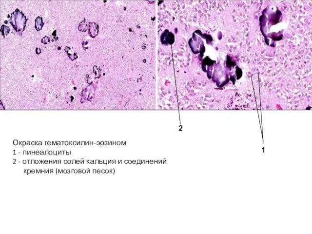 Окраска гематоксилин-эозином 1 - пинеалоциты 2 - отложения солей кальция и соединений