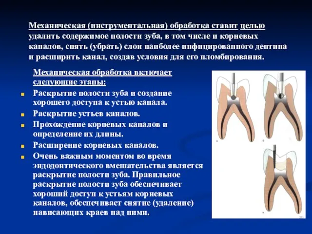 Механическая обработка включает следующие этапы: Раскрытие полости зуба и создание хорошего доступа