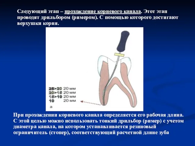 При прохождении корневого канала определяется его рабочая длина. С этой целью можно