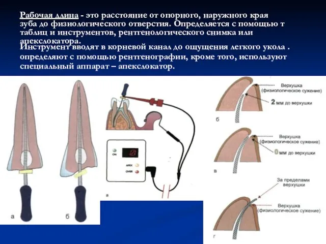 Инструмент вводят в корневой канал до ощущения легкого укола . определяют с