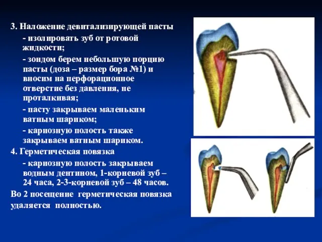 3. Наложение девитализирующей пасты - изолировать зуб от ротовой жидкости; - зондом