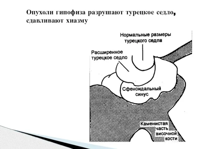 Опухоли гипофиза разрушают турецкое седло, сдавливают хиазму