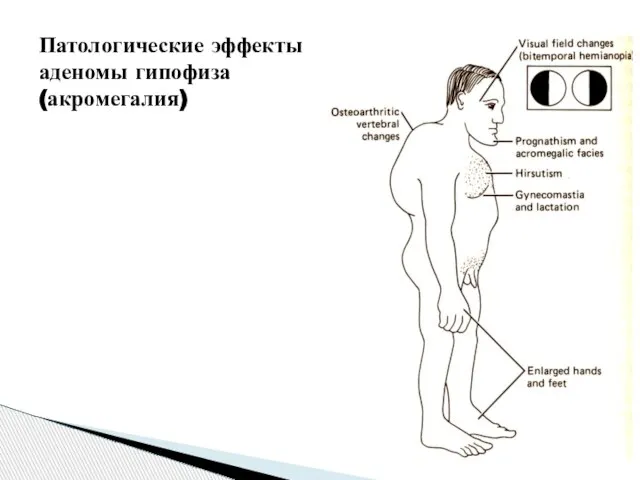 Патологические эффекты аденомы гипофиза (акромегалия)