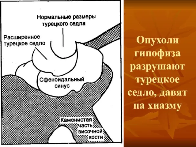 Опухоли гипофиза разрушают турецкое седло, давят на хиазму