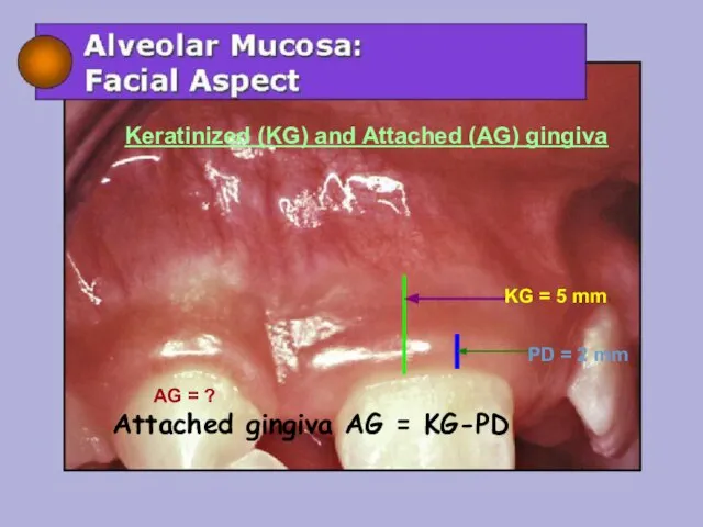 KG = 5 mm PD = 2 mm AG = ? Keratinized